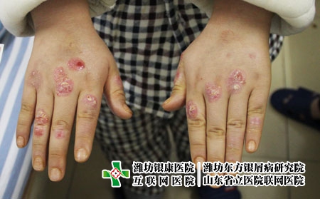 [銀屑病治療都詢濟(jì)南]怎么做才能夠有效預(yù)防牛皮癬