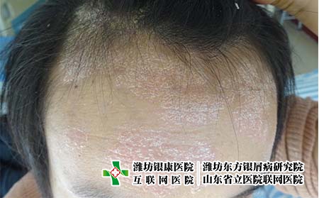 [銀屑病治療都詢濟(jì)南]怎么做才能夠有效預(yù)防牛皮癬