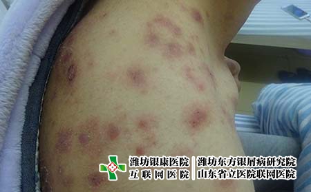 [銀屑病治療都詢濟(jì)南]怎么做才能夠有效預(yù)防牛皮癬