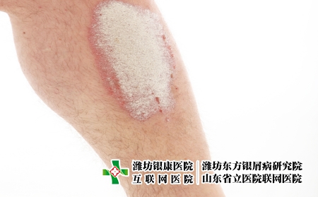 攝圖網(wǎng)_321241050_小腿上的牛皮癬或牛皮癬-特寫（企業(yè)商用）