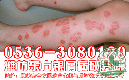 牛皮癬及時治療很關鍵
