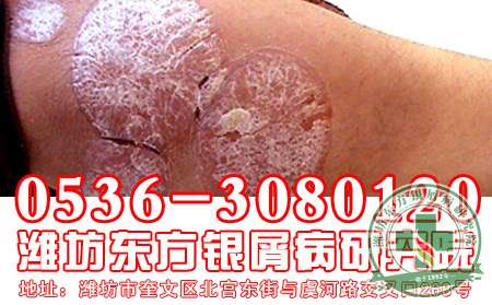 牛皮癬是不是癬？