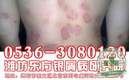 牛皮癬患者的育兒經