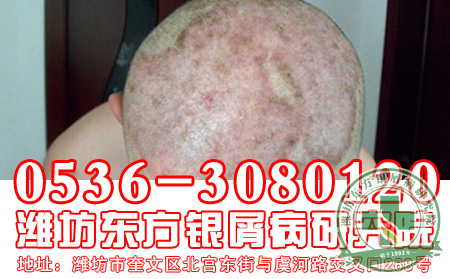 牛皮癬患者秋季護理如何進行