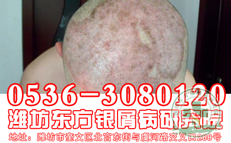 頭上有牛皮癬，理想經(jīng)常洗頭發(fā)嗎
