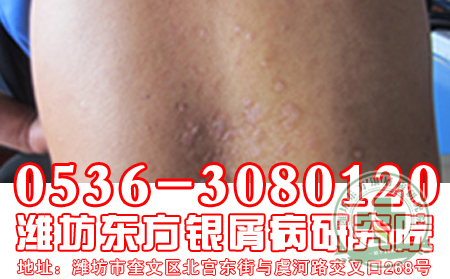 牛皮癬危害有哪些