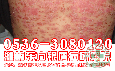 長期面對電腦會對牛皮癬患者帶來哪些危害
