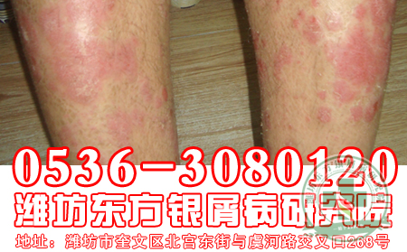 傳染會(huì)不會(huì)是導(dǎo)致銀屑病發(fā)病的誘因?