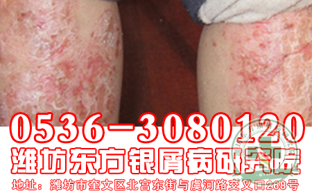 牛皮癬患者需要注意常識問題
