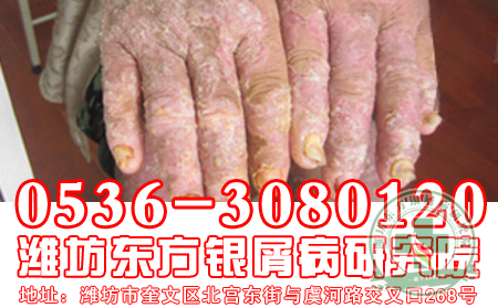 關節型牛皮癬的癥狀