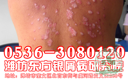 青少年牛皮癬的危害