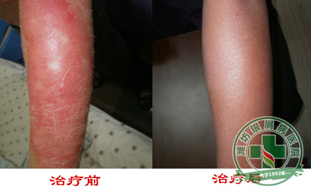 醫(yī)生忠告:牛皮癬治療不要走彎路