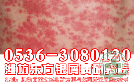 牛皮癬患者經(jīng)常泡腳會對牛皮癬的治療有輔助作用嗎