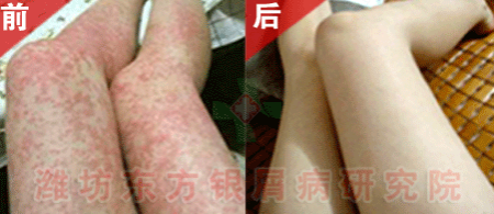 銀屑病醫(yī)院醫(yī)生簡述牛皮癬如何治療方法理想健康