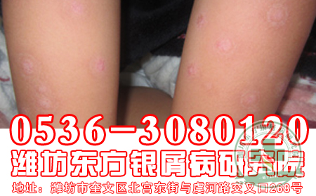尋常型牛皮癬怎么治療?