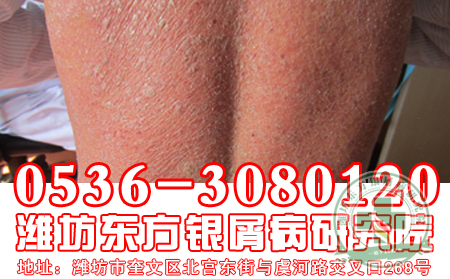 濟南牛皮癬醫院醫生解答全身性牛皮癬