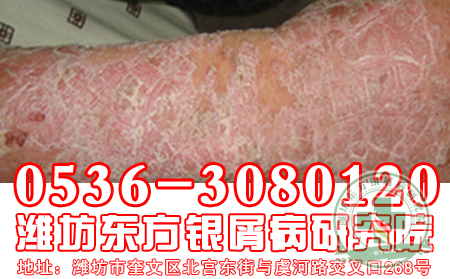 環境惡化也能引起牛皮癬?