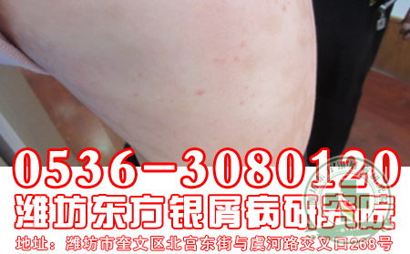 春季治療銀屑病理想時節
