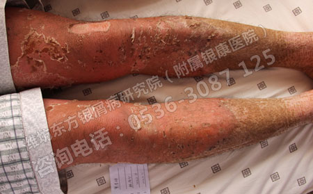 濟(jì)南專業(yè)治療牛皮癬的醫(yī)院電話