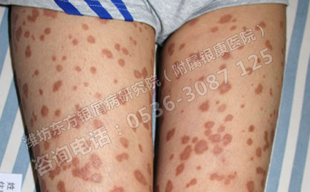 孩子得了牛皮癬這種病怎么辦