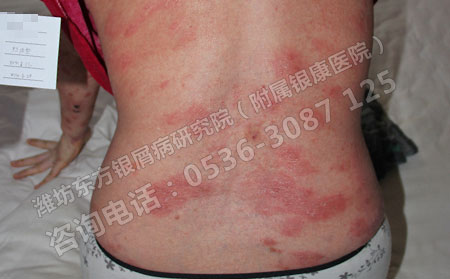 濟南哪里治銀屑病費用少
