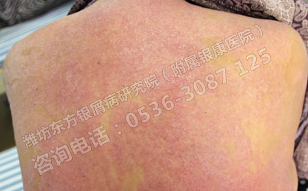 為什么治療銀屑病需要到濟南銀屑病醫院