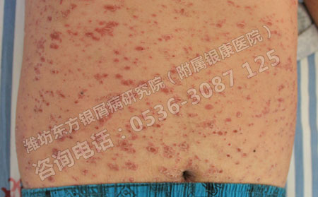 全身得了牛皮癬怎么治療優勢大