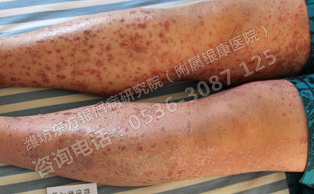 中醫辨證講述牛皮癬的治病原理