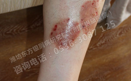 女性銀屑病的容易復(fù)發(fā)的原因是什么