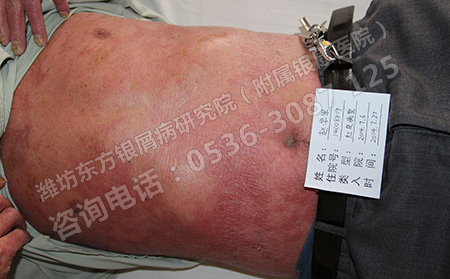全身牛皮癬的護(hù)理辦法是什么
