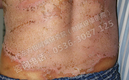 濟南治療牛皮癬醫院哪家非常理想