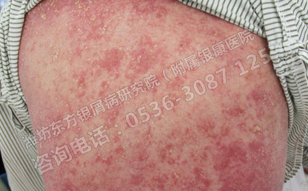 8歲孩子得了牛皮癬去哪里治理想