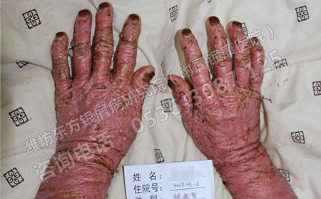 患了關(guān)節(jié)型牛皮癬怎樣保健理想