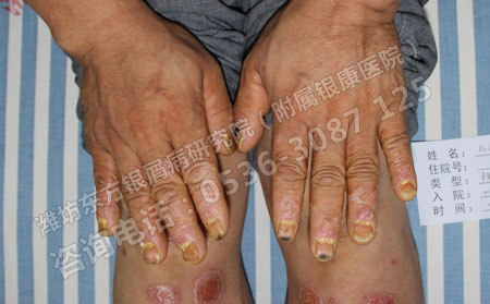 濟南銀屑病患者患者不能盲目求快