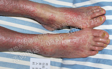 青壯年發生牛皮癬之后該怎么辦