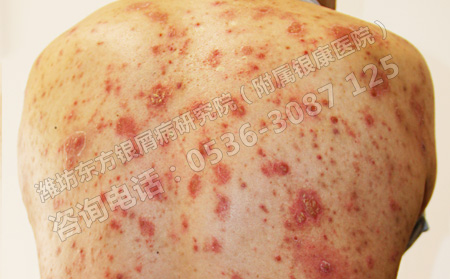 有胃病的銀屑病患者如何進行護理