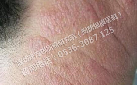 銀屑病會傳染給別人么