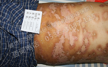濟南治療銀屑病要花多少錢