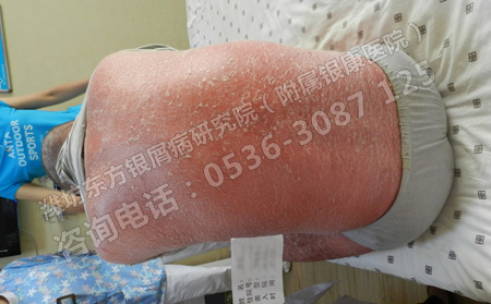銀屑病患者的皮膚如何進(jìn)行護(hù)理