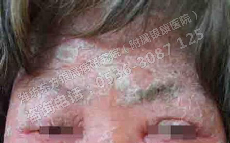 女性得了銀屑病會(huì)對(duì)胎兒產(chǎn)生哪些影響