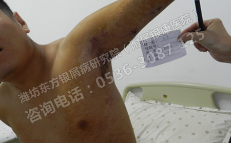 濟(jì)南預(yù)防銀屑病有沒有比較理想的方法呢