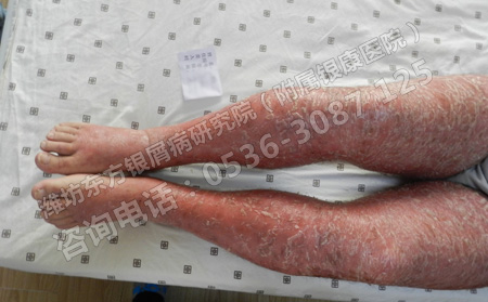 尋常型牛皮癬用什么方法治療能盡快恢復