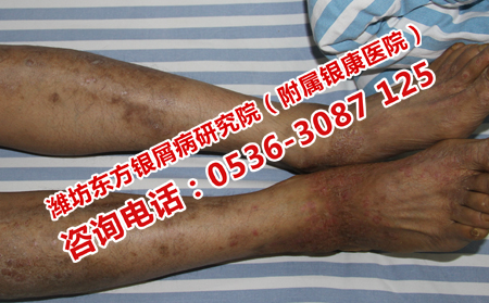 去哪里治療頑固性牛皮癬