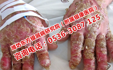 濟(jì)南牛皮癬醫(yī)院正規(guī)