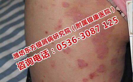 牛皮癬患者如何護理皮膚