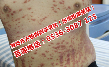 治療技術理想的牛皮癬醫(yī)院