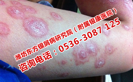 裸露位置牛皮癬的護(hù)理