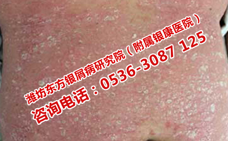濟南效果理想的牛皮癬醫(yī)院