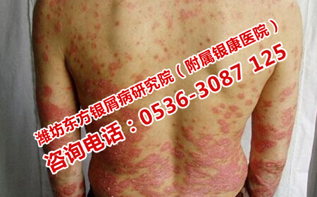 如何消除后背牛皮癬