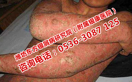 牛皮癬患者的飲食誤區